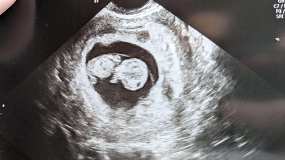 Jocelyn Kearney (@joceplays) on Twitter photo So <a href="/TACpodcast/">The Angry Chicken</a> listeners will hear about this later today, but... Matt and I are expecting this little nugget in October🥰 We are past all our previous hurdles & everything is fine! Thanks everyone for being supportive of all the schedule changes over the last couple of months. So <a href="/TACpodcast/">The Angry Chicken</a> listeners will hear about this later today, but... Matt and I are expecting this little nugget in October🥰 We are past all our previous hurdles & everything is fine! Thanks everyone for being supportive of all the schedule changes over the last couple of months.