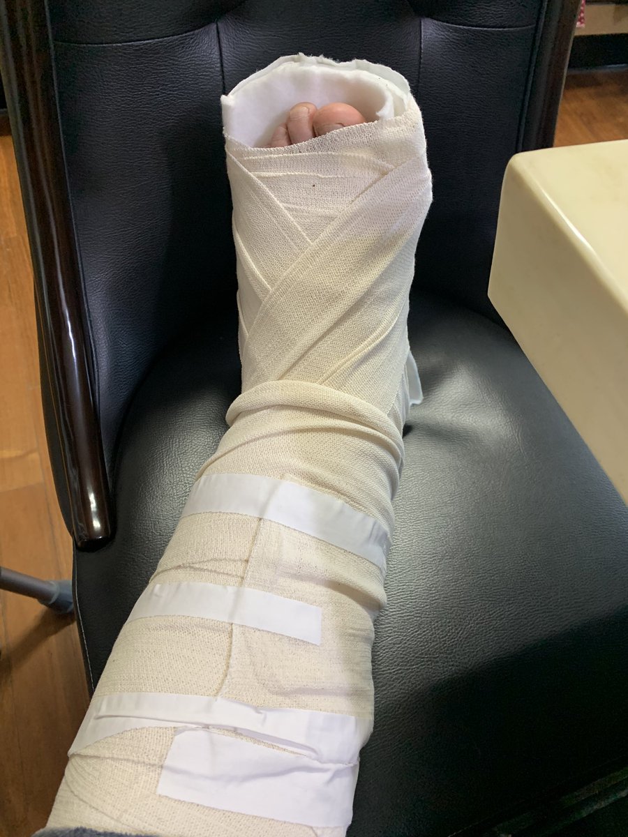 Had my foot fractured,,, 🥲