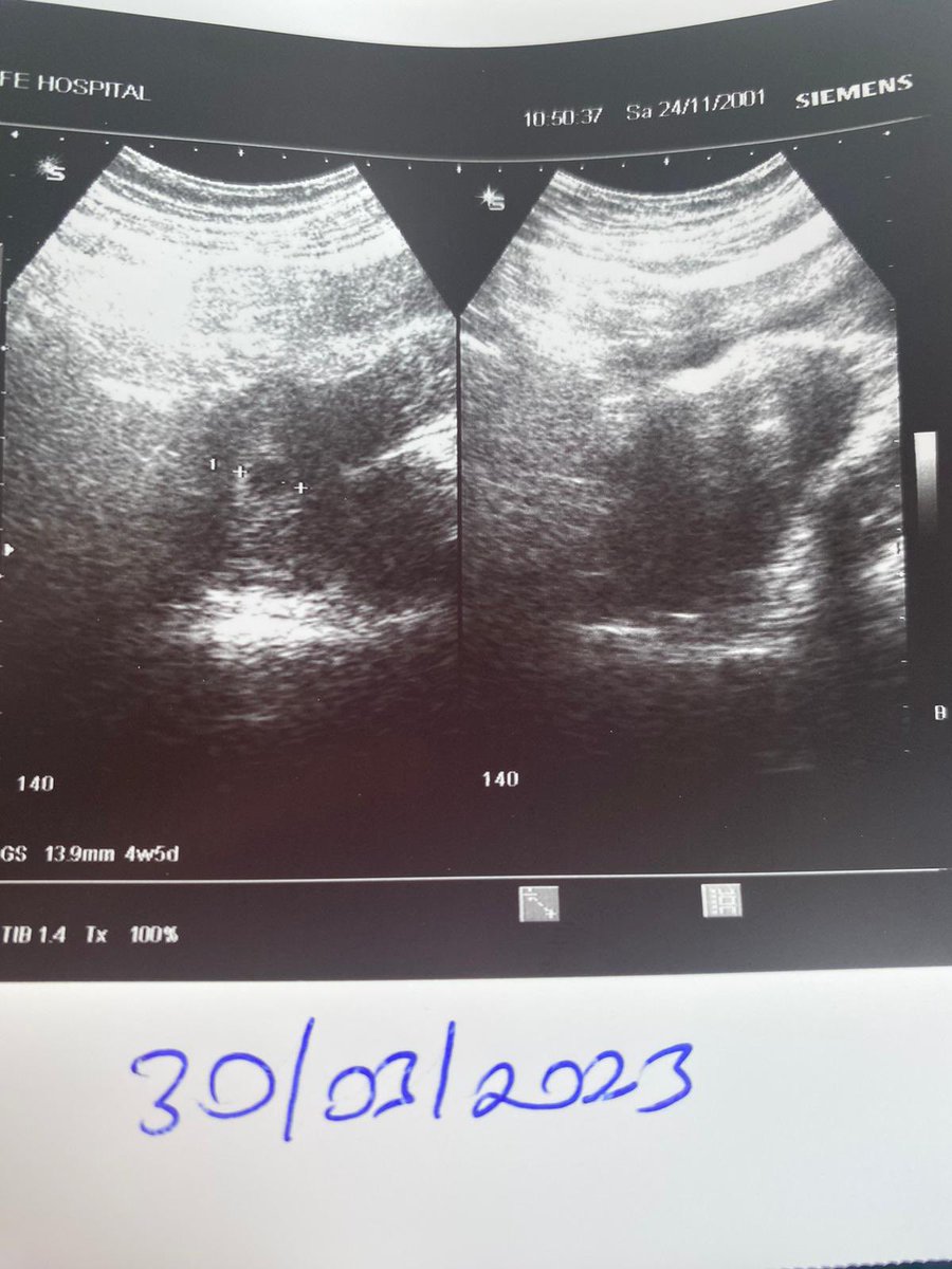 Ablam 5 yıllık evli  , hamile olduğunu öğrendik. Kuzenimi arayıp müjdemi isterim diyorum “hamilemisin lan” diyor.  Herkes ablamdan ümidi kesmişti