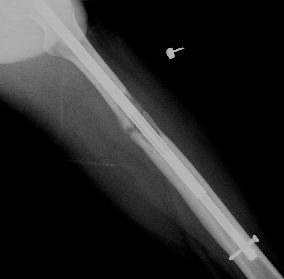 piyotaller's tweet photo. 歩くと左足がまだ痛いのだが、骨折の隙間がなくれば痛くなるのか？
歩行時にねじれが発生して痛くなってると予想してるんだけどもどうなんでしょう https://t.co/efsMaUSfYb