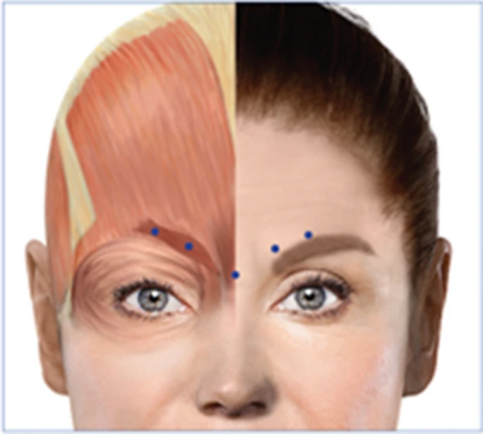 BioTay's tweet photo. 1/4 El uso de botox altera la capacidad de experimentar emociones sociales.

Los músculos de la cara son importantes en el "facial feedback" que, por ejemplo, nos hace sonreír cuando vemos una cara feliz. Bloquear su actividad altera el cerebro (paper) https://t.co/k3Q2Uexoyn https://t.co/N6WCcd7VEU