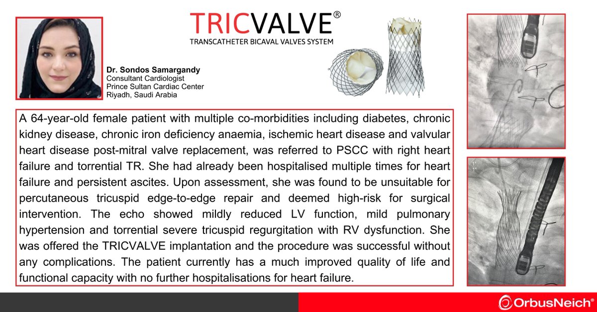 Congratulations Dr. Sondos Samargandy on a great first TRICVALVE® case at Prince Sultan Cardiac Center Riyadh! buff.ly/404pRd9 #cardiotwitter