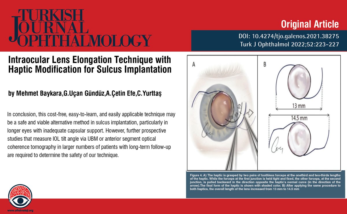 TurkJOphthalmol's tweet photo. Intraocular Lens Elongation Technique with Haptic Modification for Sulcus Implantation

You can see the free full text of the research by Mehmet Baykara et al.

Link : https://t.co/T4DafRPf8q

#Aphakia #ciliarysulcus #intraocularlens #implantation #lensdislocation https://t.co/lfelDm53YN