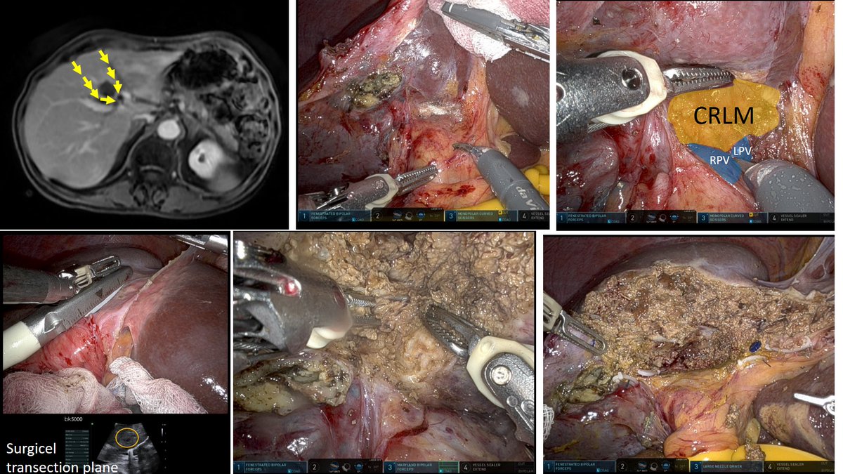 Robot assisted liver resection of a colorectal liver metastasis at the portal bifurcation. Technology 🤖 turns a tricky 🤔 racetrack 🚧 into an easy ride 🏎️. @SAGES_Updates @ILLS_LAPLIVER @IHPBA @EAES_eu @myESMO