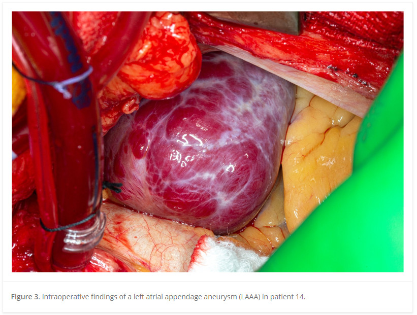 MayoClinicCVS's tweet photo. Several experts including @MayoClinicCV M. Penfold MD, S. Asirvatham MD, @MayoClinicCVS @JosephDearaniMD &amp; @Arghami discuss atrial appendage aneurysms: natural history and outcomes in this intresting #Sagejournal article.
https://t.co/DsH2XcaIsV https://t.co/AO6mR5INAJ
