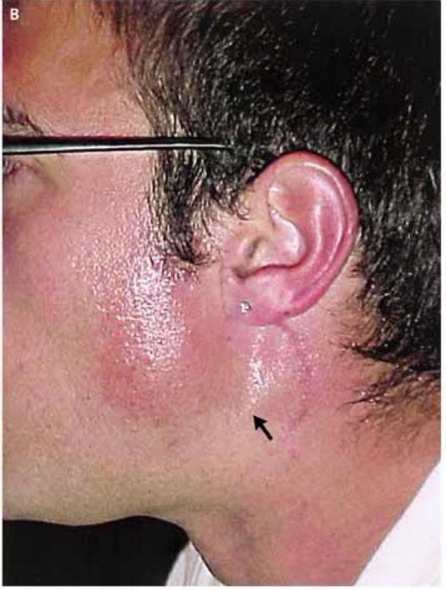 BrownJHM's tweet photo. A 36-year-old male came with episodic flushing, burning sensation, &amp; sweating on his left cheek after eating (especially spicy food). He had a hx of a bicycle accident &amp; surgery for mandibular condyle fracture. What is the likely diagnosis? #Medtwitter https://t.co/t2DXcMdzMb https://t.co/zpyfNQX7ts