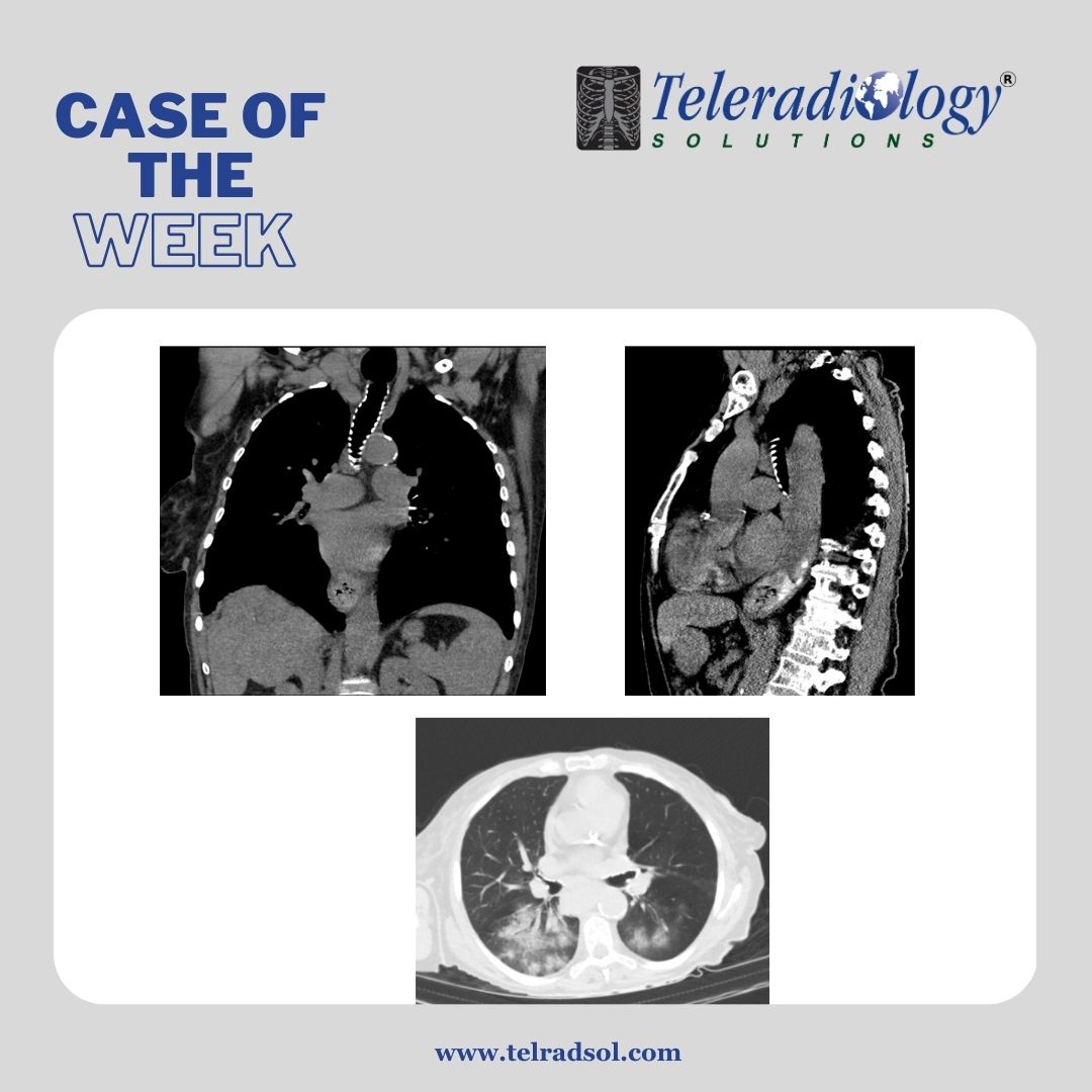 teleradsol's tweet photo. What's the Diagnosis?
See the answer at https://t.co/vcQNl6A4Gh

#teleradiology #radiology #healthcare #medical #learning #LearningRadiology #practicingradiology #interventionalradiology #MRI #imaging #medicalimaging #ultrasoundscan #ctscan #telradsol #teleradiologysolution https://t.co/0OzFhZ4SQr