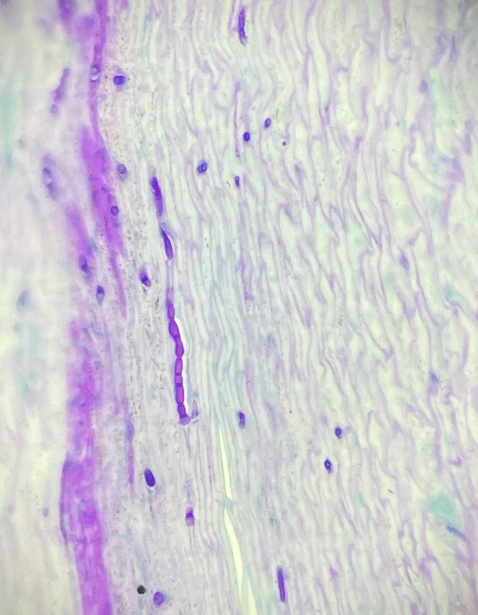 Nice Monday afternoon fungal nail infection! Has anyone else found microscopic iPhoneography even more of a challenge now there are so many lenses? 😅 #dermpath