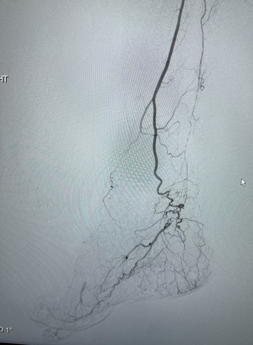 limbsalvagedr's tweet photo. Progression of disease sucks...fem-BK pop with three vessel runoff is now a functional fem-peroneal with significant intrinsic foot disease hence the monophasic AT and PT waveforms on duplex...bypass widely patent 🙏🏼 #vascularcancer #WIfI #appropriatecare https://t.co/R1myAm3fZX