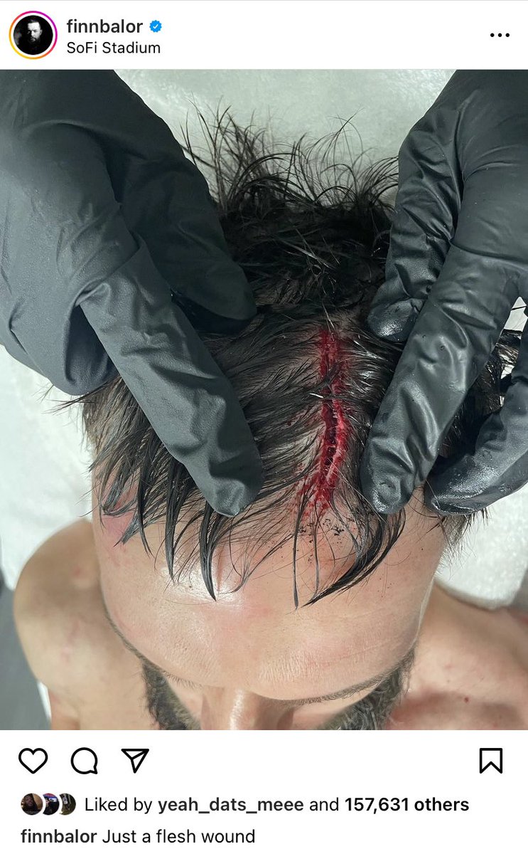 PublicEnemiesHQ's tweet photo. Edge split that boy Finn Balor’s cranium open last night 😬 https://t.co/ReYsaMj49C