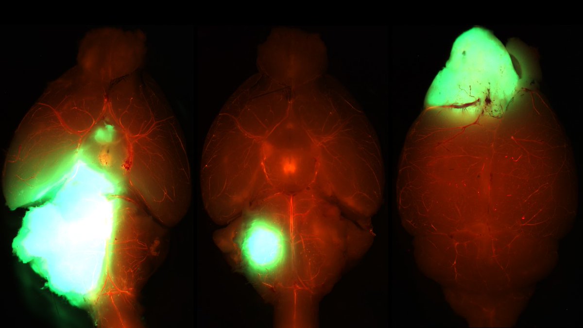 Manav Pathania | @manavpathania.bsky.social (@pathania_lab) on Twitter photo First Pathania Lab paper in <a href="/CD_AACR/">Cancer Discovery</a>: bit.ly/3K5xA3J. We developed 16 mouse models of various subtypes of pediatric high-grade glioma— mirroring their different H3 mutant contexts, anatomical compartmentalizations and co-segregating partner alterations. Thread below 1/17 First Pathania Lab paper in <a href="/CD_AACR/">Cancer Discovery</a>: bit.ly/3K5xA3J. We developed 16 mouse models of various subtypes of pediatric high-grade glioma— mirroring their different H3 mutant contexts, anatomical compartmentalizations and co-segregating partner alterations. Thread below 1/17