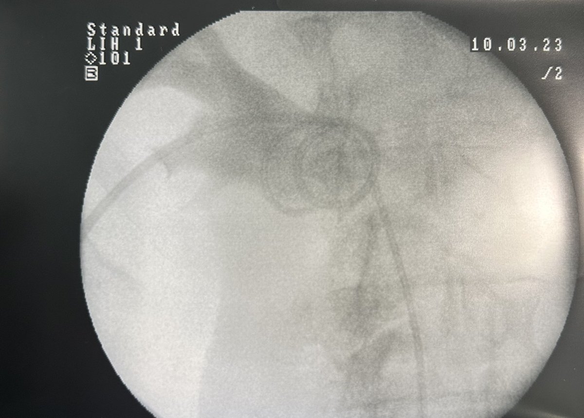 lorusso_MD's tweet photo. Today challenging case performed with Dr. @MicheleTalso at #ASSTFatebenefratelli Hospital.
Pt w/ 2cm distal ureteral stone, stenotic orifice + median lobe ▶️ Percutaneous(P)-URS. @AndreaGreg001 

#urology #UroSoMe #lithiasis #ASSTFatebenefratelliSacco #Milan #PURS #surgery https://t.co/p3ZWrZnQVs