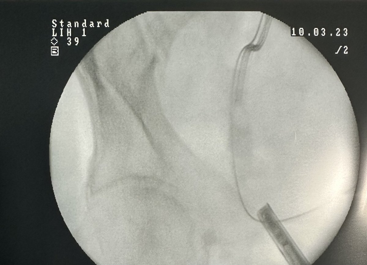 lorusso_MD's tweet photo. Today challenging case performed with Dr. @MicheleTalso at #ASSTFatebenefratelli Hospital.
Pt w/ 2cm distal ureteral stone, stenotic orifice + median lobe ▶️ Percutaneous(P)-URS. @AndreaGreg001 

#urology #UroSoMe #lithiasis #ASSTFatebenefratelliSacco #Milan #PURS #surgery https://t.co/p3ZWrZnQVs