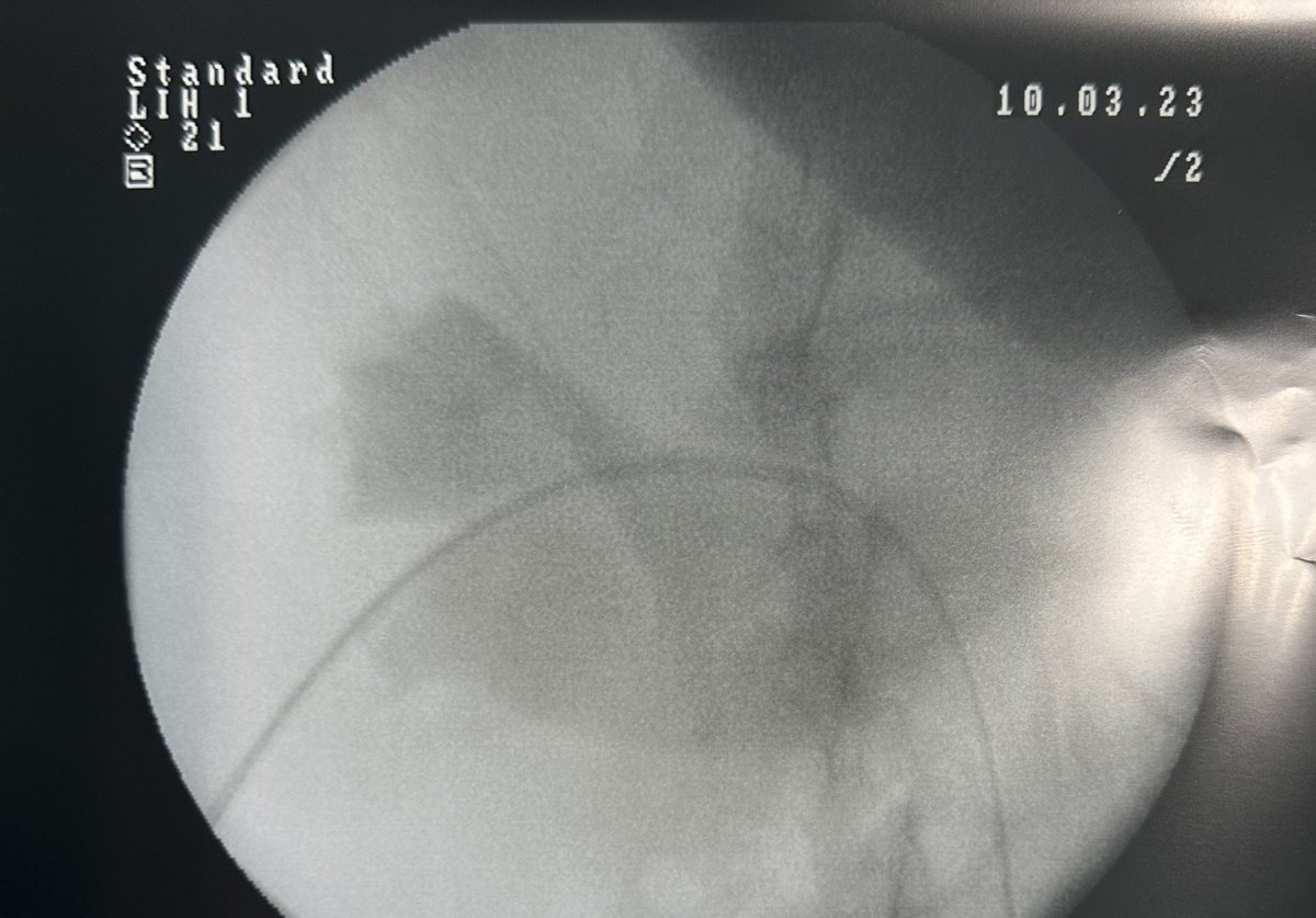 lorusso_MD's tweet photo. Today challenging case performed with Dr. @MicheleTalso at #ASSTFatebenefratelli Hospital.
Pt w/ 2cm distal ureteral stone, stenotic orifice + median lobe ▶️ Percutaneous(P)-URS. @AndreaGreg001 

#urology #UroSoMe #lithiasis #ASSTFatebenefratelliSacco #Milan #PURS #surgery https://t.co/p3ZWrZnQVs