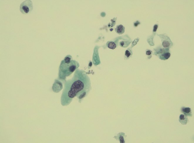 pathgurl21's tweet image. 🧓🏼90yo. Urinary cytology. The patient presents a bladder tumor. #PathTwitter #pathology #Cytology #cytopath 👀