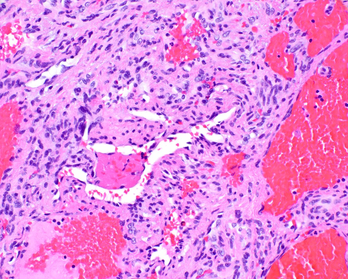 Jerad Gardner, MD on Twitter "RT science_press Spindle cell