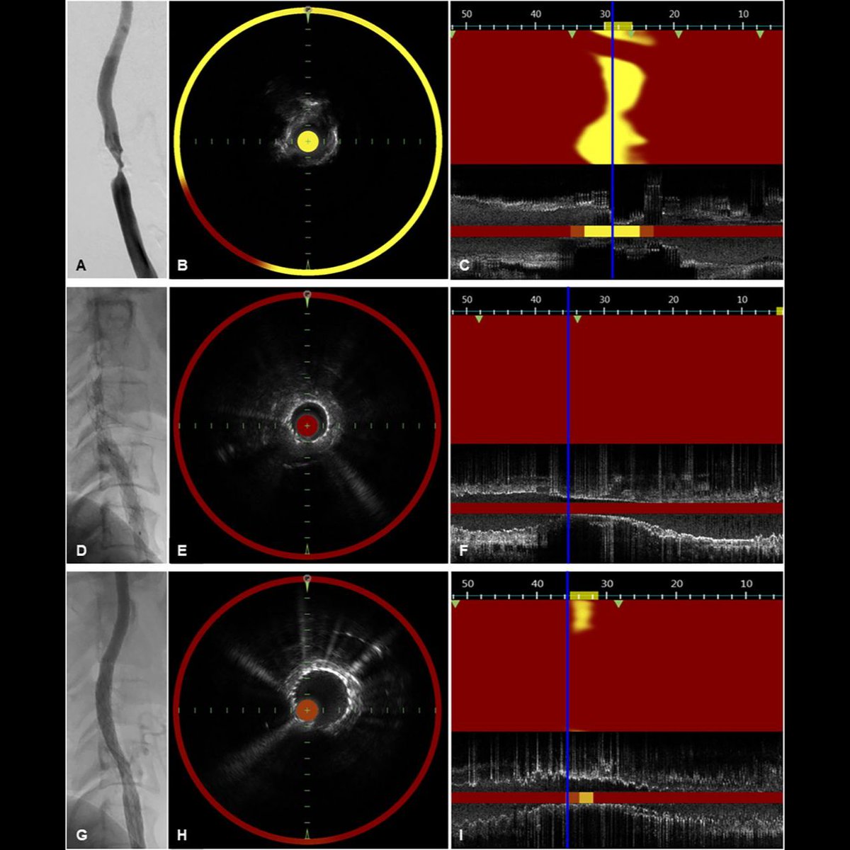 Latest content: bit.ly/3Gdxs0V Nakagawa et al. found that dual-layered stents reduce embolic infarcts in patients with high lipid core plaque and change of lipid signal as assessed by near-infrared spectroscopy in carotid artery stenting. #strokeprevention #endovascular