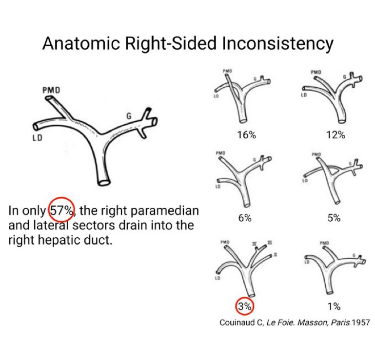 Bile ducts right-sided inconsistency 👉 Right hepatic duct is absent in 43% ≠ left hepatic duct absent in only 3%  #HPB #surgery👇 #oncsurgery @IHPBA @EAHPBA @AHPBA @SSATNews @SocSurgOnc @hpb_so @DenboJw @timnewhook19  @HopSTranCao @MDAndersonNews