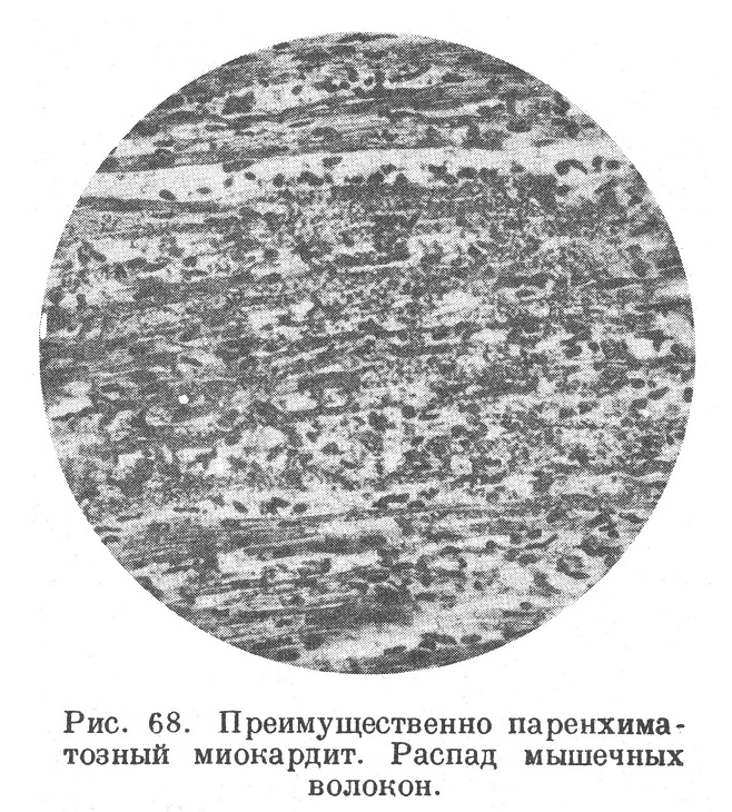 anatomia17's tweet photo. Миокардит (myocarditis) представляет собой воспаление мышцы сердца. Однако с самого начала надо заметить, что в клинике уже издавна установилась традиция термин «миокардит» применять по отношению к самым разнообразным изменениям миокарда не воспалительного
https://t.co/S4GXLUCqLn https://t.co/vOXmOBkvtT
