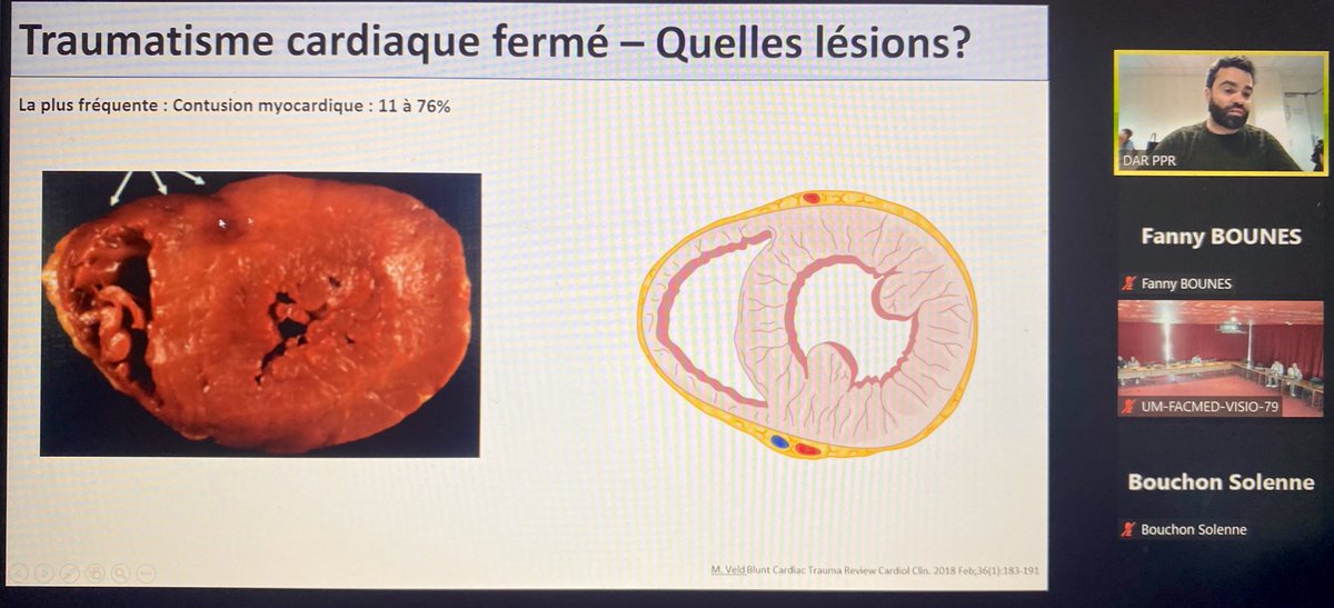 POpART (@popartoulouse) on Twitter photo Cours sur les traumatismes cardiaques par le Dr <a href="/LabasteF/">Labaste François</a> au #DUTraumaGrave du réseau <a href="/TraumaOcci/">Réseau Occi.TRAUMA</a> <a href="/POpARToulouse/">POpART</a> Cours sur les traumatismes cardiaques par le Dr <a href="/LabasteF/">Labaste François</a> au #DUTraumaGrave du réseau <a href="/TraumaOcci/">Réseau Occi.TRAUMA</a> <a href="/POpARToulouse/">POpART</a>