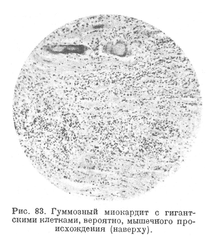 anatomia17's tweet photo. Сифилитическое поражение сердца
При сифилитическом поражении аорты, т. е. при сифилитическом мезаортите, процесс очень часто с аорты переходит на полулунные заслонки аортального клапана.
https://t.co/hMtEknzeQ6 https://t.co/HE7XYQCnEn