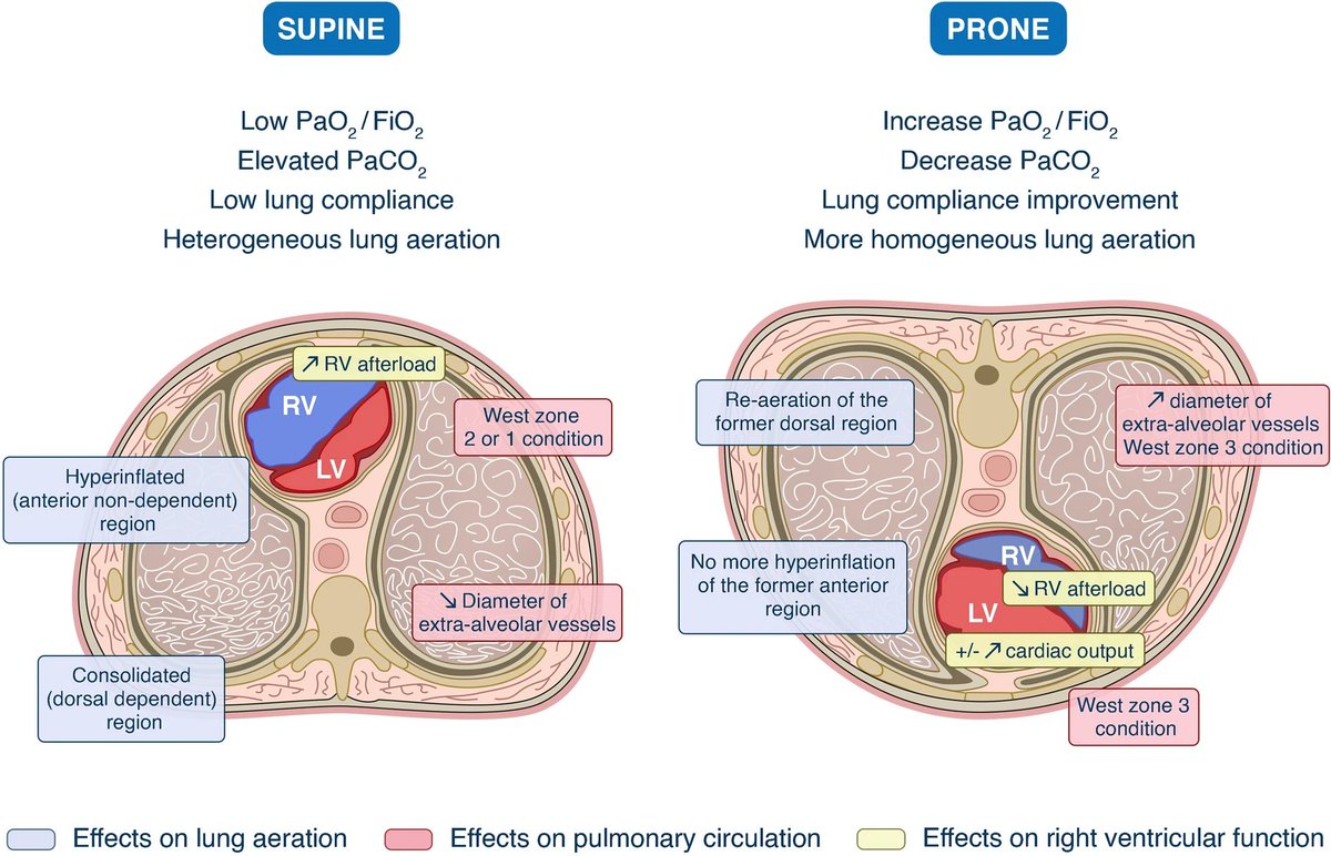 NephroPOCUS on Twitter "Graphic representation of the effects of prone