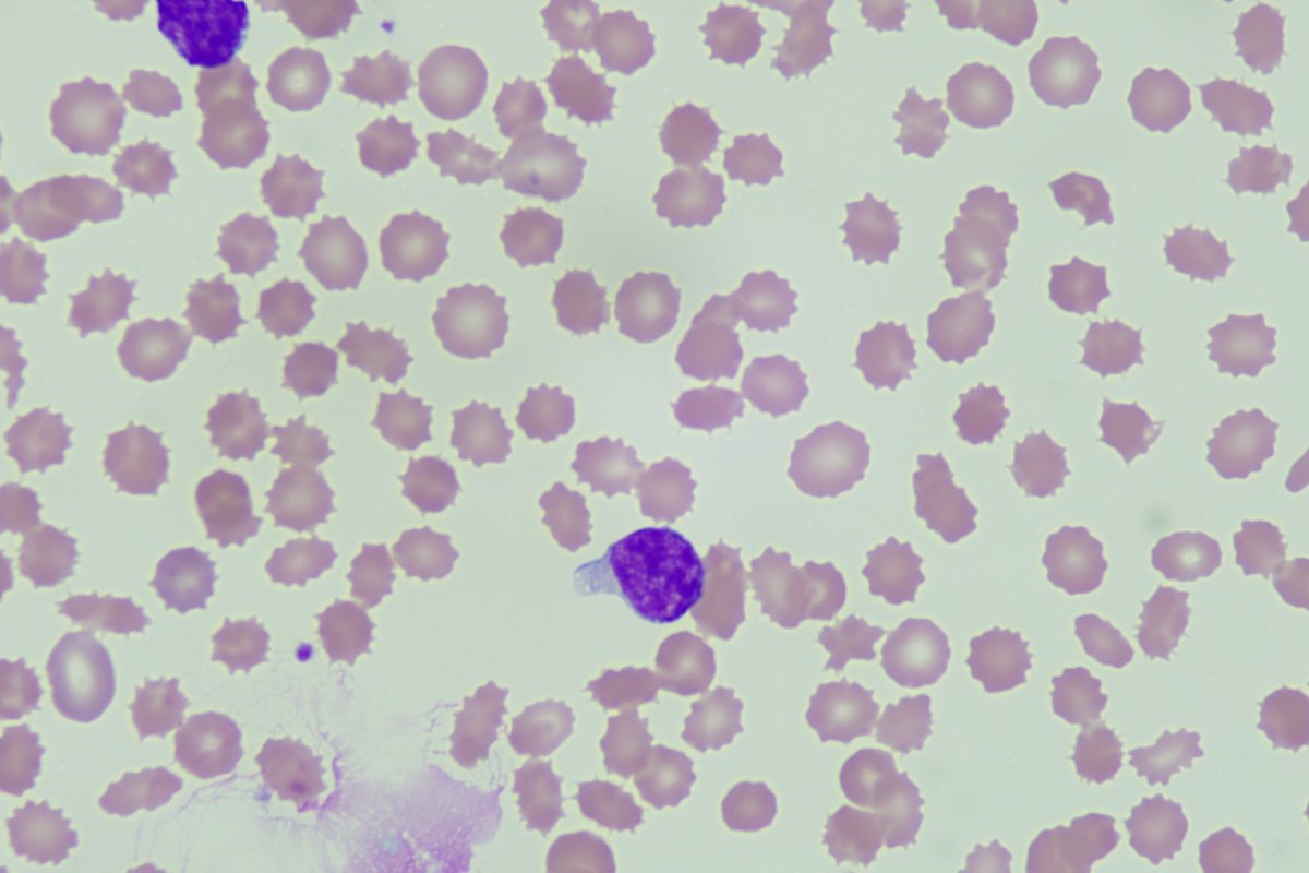 diff_discussion's tweet image. We review another ALL peripheral blood slide, this one has blasts with hand mirror morphology youtu.be/i7vlYq8xUn4