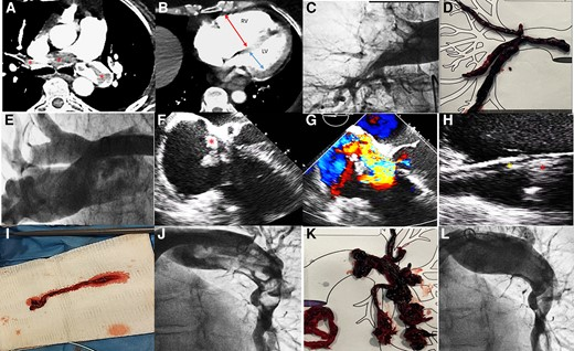 Successful aspiration of an iatrogenic clot in transit secondary to a failed mechanical thrombectomy in pulmonary embolism 
Congrats @Ana_Viana_T @pabl0salinas !!! academic.oup.com/eurheartj/arti…
