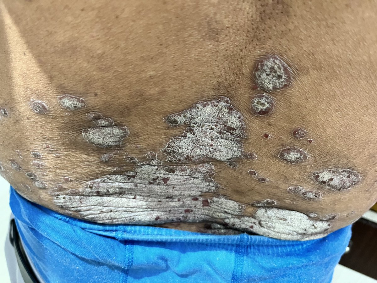 DrAKDIndore's tweet image. skin Pateints homeopathic treatment 
SKin care clinic 
Dr AK Dwivedi 
Advanced Homeo Health Centre 8/9,Mayank Apartment
Ground Floor
Geeta Bhawan Road
Manorama Ganj Indore
Madhya Pradesh 
0731 4064471 
9993700880 
#Leucoderma 
#Eczema 
#Psoriasis 
#Itching 
#Dermatitis 
#Allergy