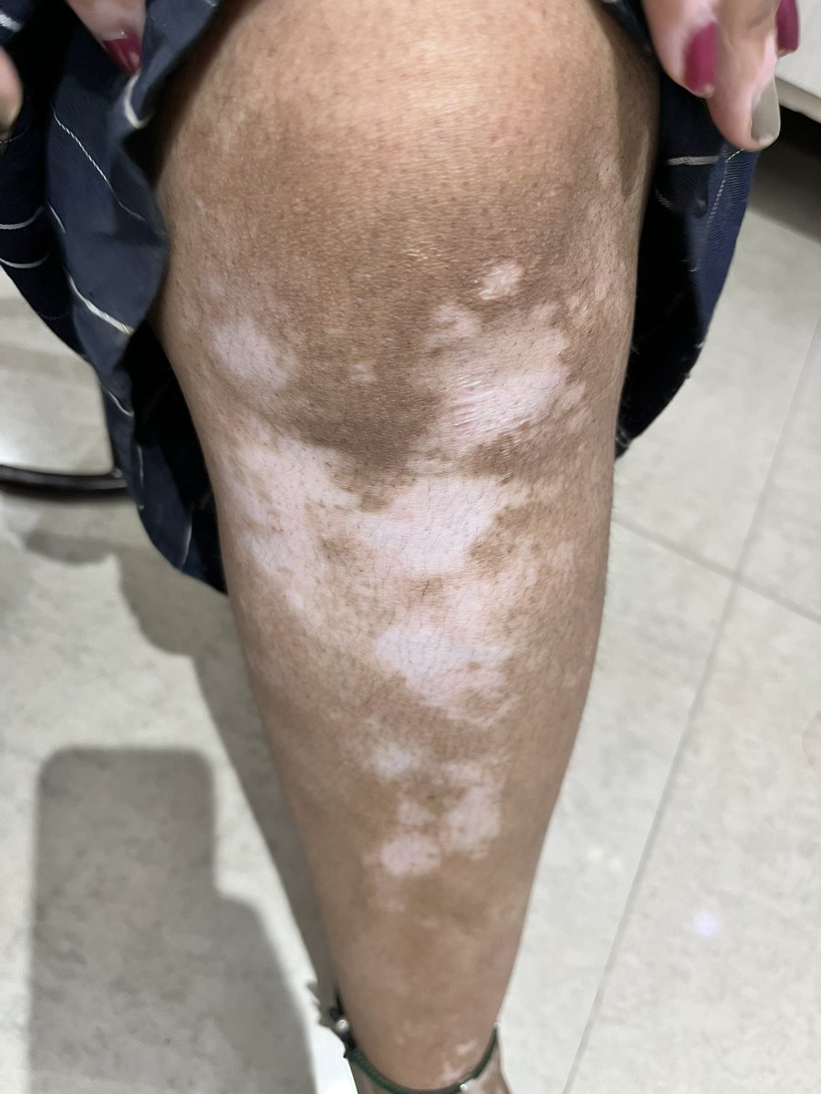 DrAKDIndore's tweet image. skin Pateints homeopathic treatment 
SKin care clinic 
Dr AK Dwivedi 
Advanced Homeo Health Centre 8/9,Mayank Apartment
Ground Floor
Geeta Bhawan Road
Manorama Ganj Indore
Madhya Pradesh 
0731 4064471 
9993700880 
#Leucoderma 
#Eczema 
#Psoriasis 
#Itching 
#Dermatitis 
#Allergy