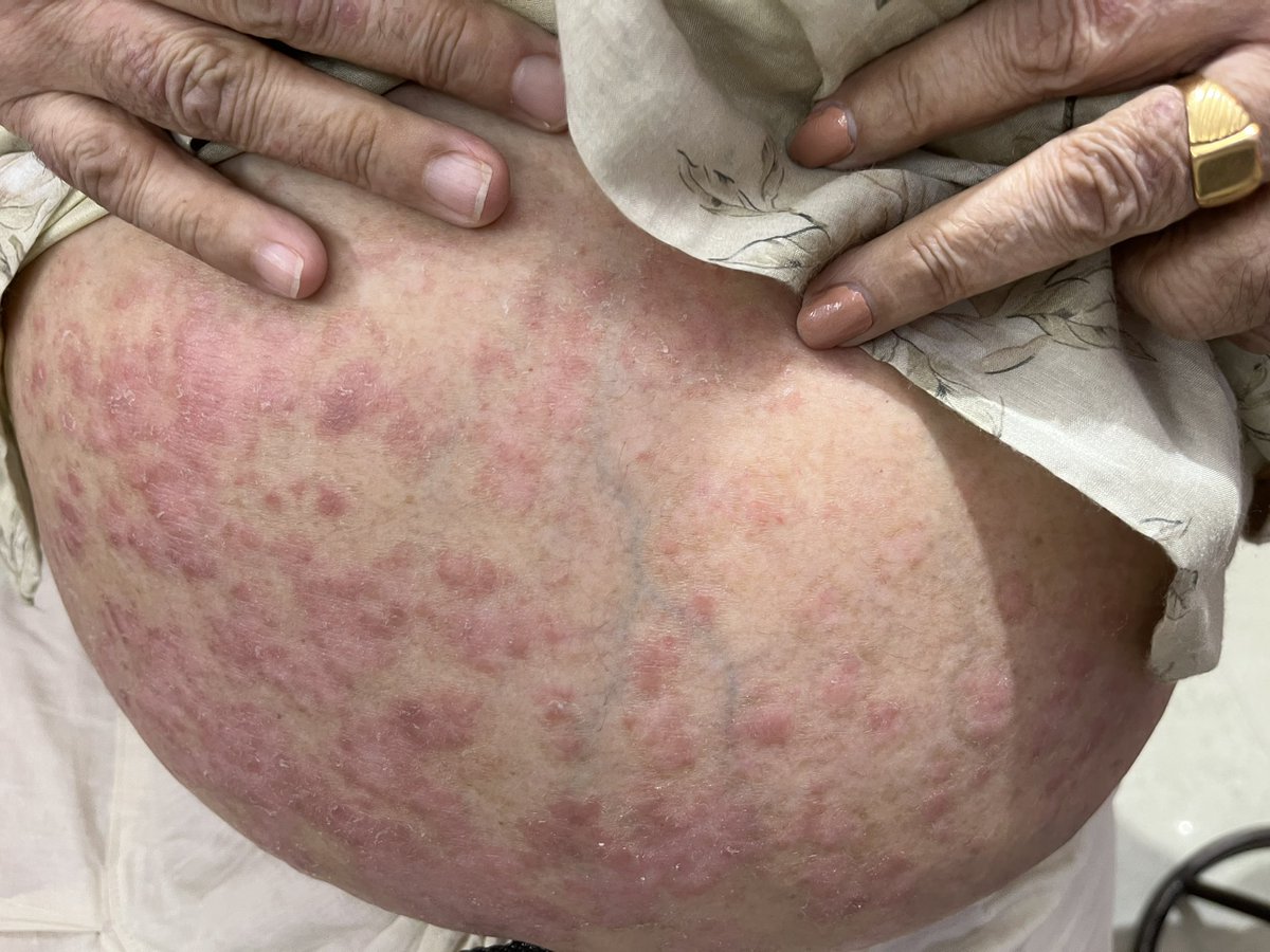 DrAKDIndore's tweet image. skin Pateints homeopathic treatment 
SKin care clinic 
Dr AK Dwivedi 
Advanced Homeo Health Centre 8/9,Mayank Apartment
Ground Floor
Geeta Bhawan Road
Manorama Ganj Indore
Madhya Pradesh 
0731 4064471 
9993700880 
#Leucoderma 
#Eczema 
#Psoriasis 
#Itching 
#Dermatitis 
#Allergy