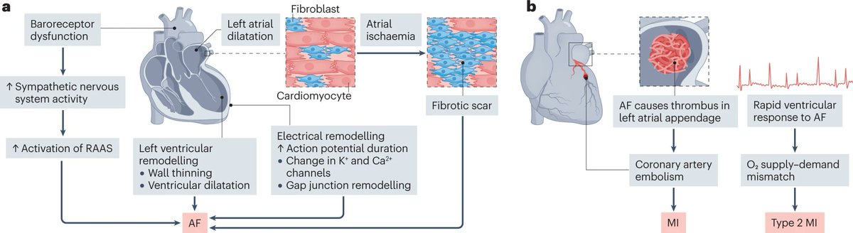 Tanja Charlotte Frederiksen (@tanjacharlottef) on Twitter photo In this review, published in <a href="/NatRevCardiol/">Nature Reviews Cardiology</a>, my colleagues and I describe the evidence on the bidirectional association #AFib and myocardial infarction. We identify gaps in the literature and propose future study directions.
Read the full article here 👇
lnkd.in/egwUQT2N In this review, published in <a href="/NatRevCardiol/">Nature Reviews Cardiology</a>, my colleagues and I describe the evidence on the bidirectional association #AFib and myocardial infarction. We identify gaps in the literature and propose future study directions.
Read the full article here 👇
lnkd.in/egwUQT2N