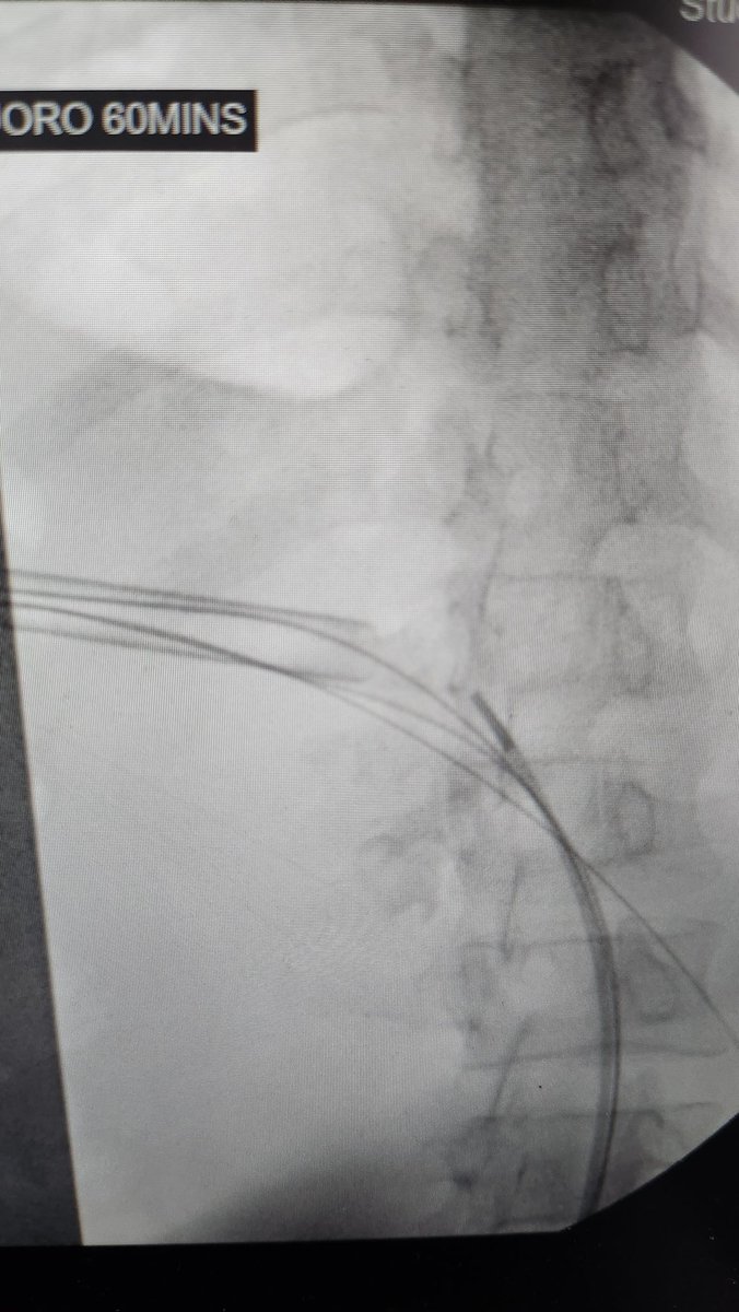 doc_sarvajit's tweet photo. Amidst a busy operating week with 4 #HoLEPs, Lap NephroU, #RIRS, the most satisfying was a
Large staghorn calculus.
Traditional Prone, Single, Supra 12 🎯
Op time 59min(from T6 to PCN)
#shockpulse time 5 min.
💯 SFR, No CIRF, No Dust.
#proneisheretostay @Olympus_Corp
#UroSoMe https://t.co/xfDBu5iKJH