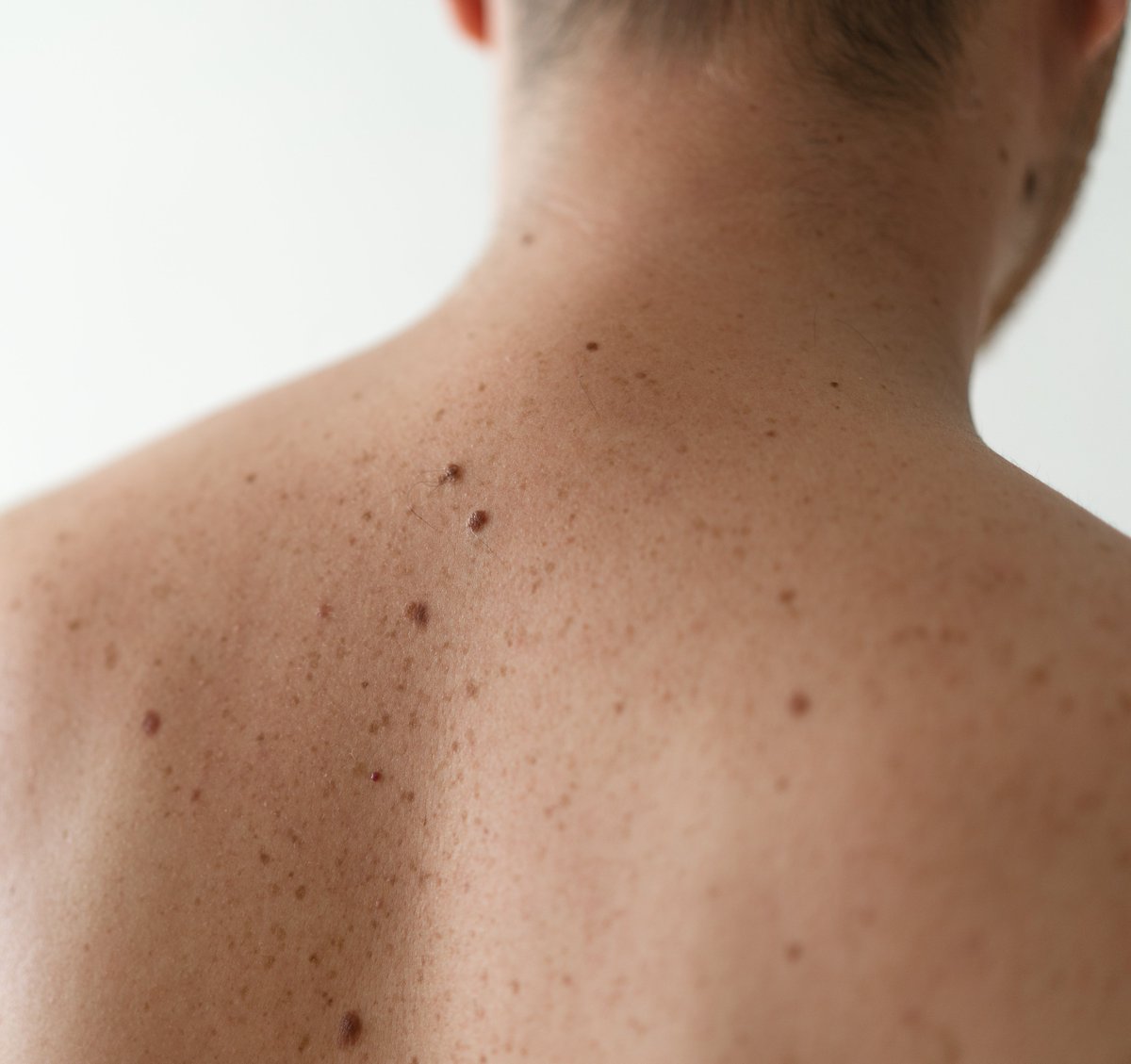 melanomasupport's tweet photo. Early detection is key!
When did you last have a skin check?
#melanoma #melanomaawareness #checkyourskin https://t.co/2BDaUwGTwy