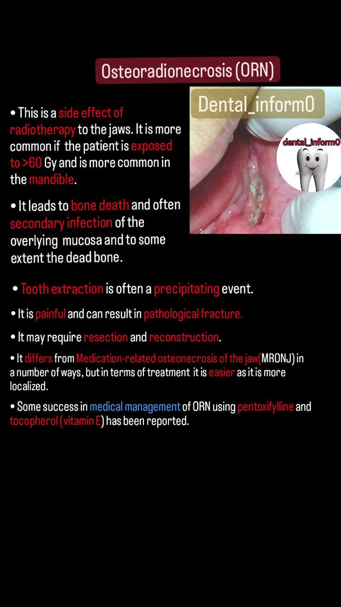 Osteoradionecrosis (ORN).

By @dental_inform0

References : Oxford Handbook of  Oral and MaxillofacialSurgery