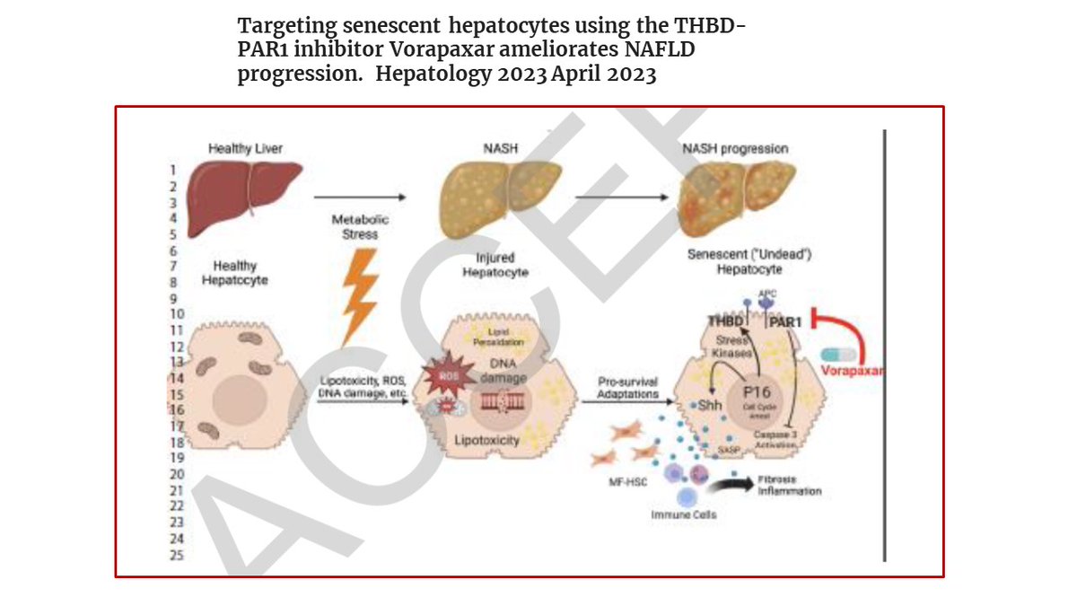 NAFLD article of the week @IUGastro Nice @HEP_Journal paper from AM Diehl 1⃣Senescence ⬆️THBD-PAR1 axis ⬆️fibrogenic factors 2⃣ Inhibition of PAR1 signaling w/vorapaxar interrupts THBD-PAR1 axis 3⃣ Improves NASH and fibrosis 4⃣ ?Unitended consequences pubmed.ncbi.nlm.nih.gov/37036206/