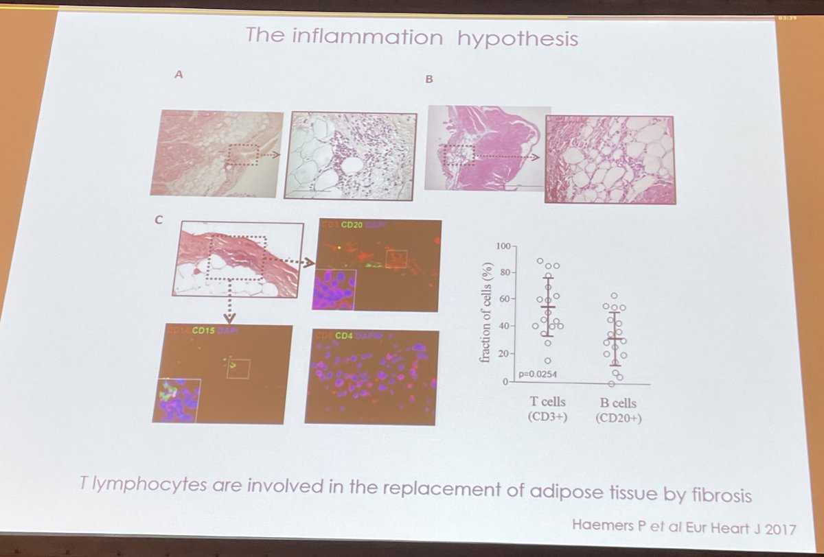 Carol Ann Remme (@carolremme) on Twitter photo Excellent overview by <a href="/HatemStephane/">Stephane N Hatem</a> on the various pro-arrhythmic consequences of epicardial adipose tissue in #AtrialFibrillation
#EHRA2023 #basicEP #translationalEP <a href="/HenrikeHillmann/">Henrike Hillmann</a> <a href="/Raquel_Adelino/">Raquel Adeliño</a> <a href="/micaela_ebert/">Micaela Ebert</a> Excellent overview by <a href="/HatemStephane/">Stephane N Hatem</a> on the various pro-arrhythmic consequences of epicardial adipose tissue in #AtrialFibrillation
#EHRA2023 #basicEP #translationalEP <a href="/HenrikeHillmann/">Henrike Hillmann</a> <a href="/Raquel_Adelino/">Raquel Adeliño</a> <a href="/micaela_ebert/">Micaela Ebert</a>
