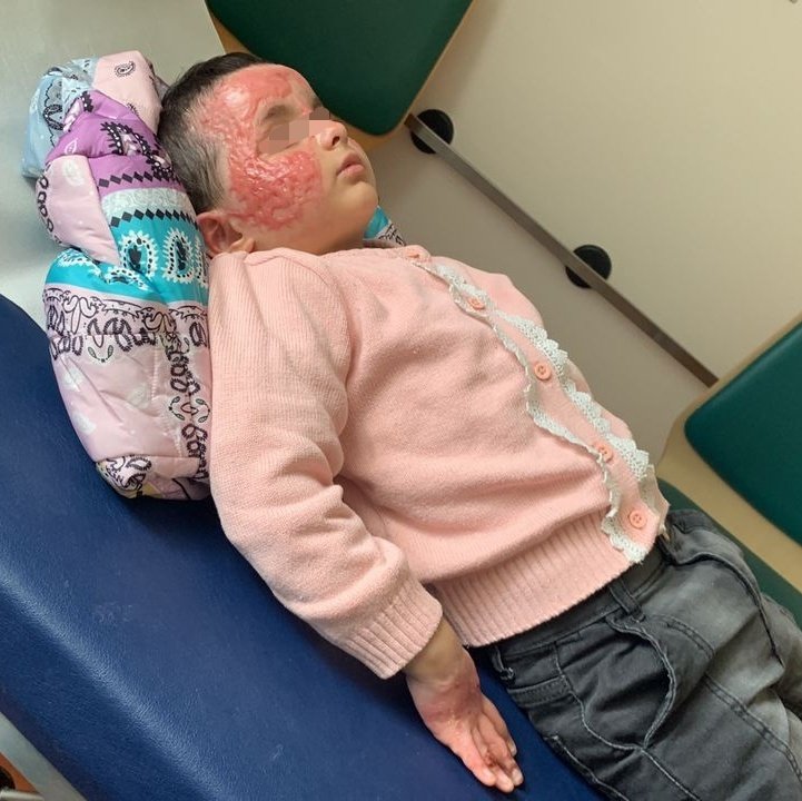 cmqkate's tweet photo. Suche DRINGEND Termin bei Dermatologen im Raum #Gotha in #Thüringen für Brandopfer. Eine liebe Familie, die über ein humanitäres Visum aus #Afghanistan gekommen ist, konnte nun endlich mit den übrigen Angehörigen vereint werden. Diese sind im Januar in Pakistan durch die #GIZ
1/4 https://t.co/tRmikuifcU