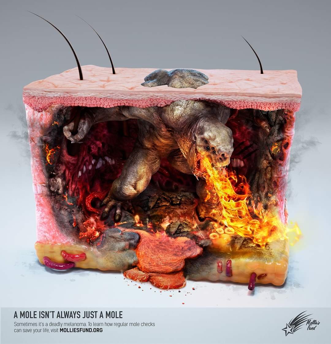 InformaCosmos's tweet photo. MONSTRUOS DE MELANOMA.

Estas ilustraciones son parte de una campaña publicitaria que pretende concientizar sobre el cáncer de piel.

Estas imágenes fueron publicadas por Medical Sources HD, para dar un mensaje claro: no todo lunar o bulto en la piel es insignificante.

Siempre debemos tener cuidado de cualquier señal lo insignificante que parezca, a veces esa manchita en la piel, puede esconder algo terrible y aterrador.

Como pueden ver, las ilustraciones son realmente impresionantes. Nos dan otro concepto de cómo se vería el cáncer de piel, y el daño que nos ocasionaría.

* El melanoma es un tipo de cáncer de piel que se origina cuando los melanocitos (las células que dan a la piel su color bronceado o marrón) comienzan a crecer fuera de control.

El melanoma también puede manifestarse en los ojos y, rara vez, dentro del cuerpo, como en la nariz o la garganta.

La causa exacta de todos los melanomas no está clara, pero la exposición a la radiación ultravioleta (UV) de la luz solar o de las lámparas y de las camas solares aumenta el riesgo de tener melanoma.