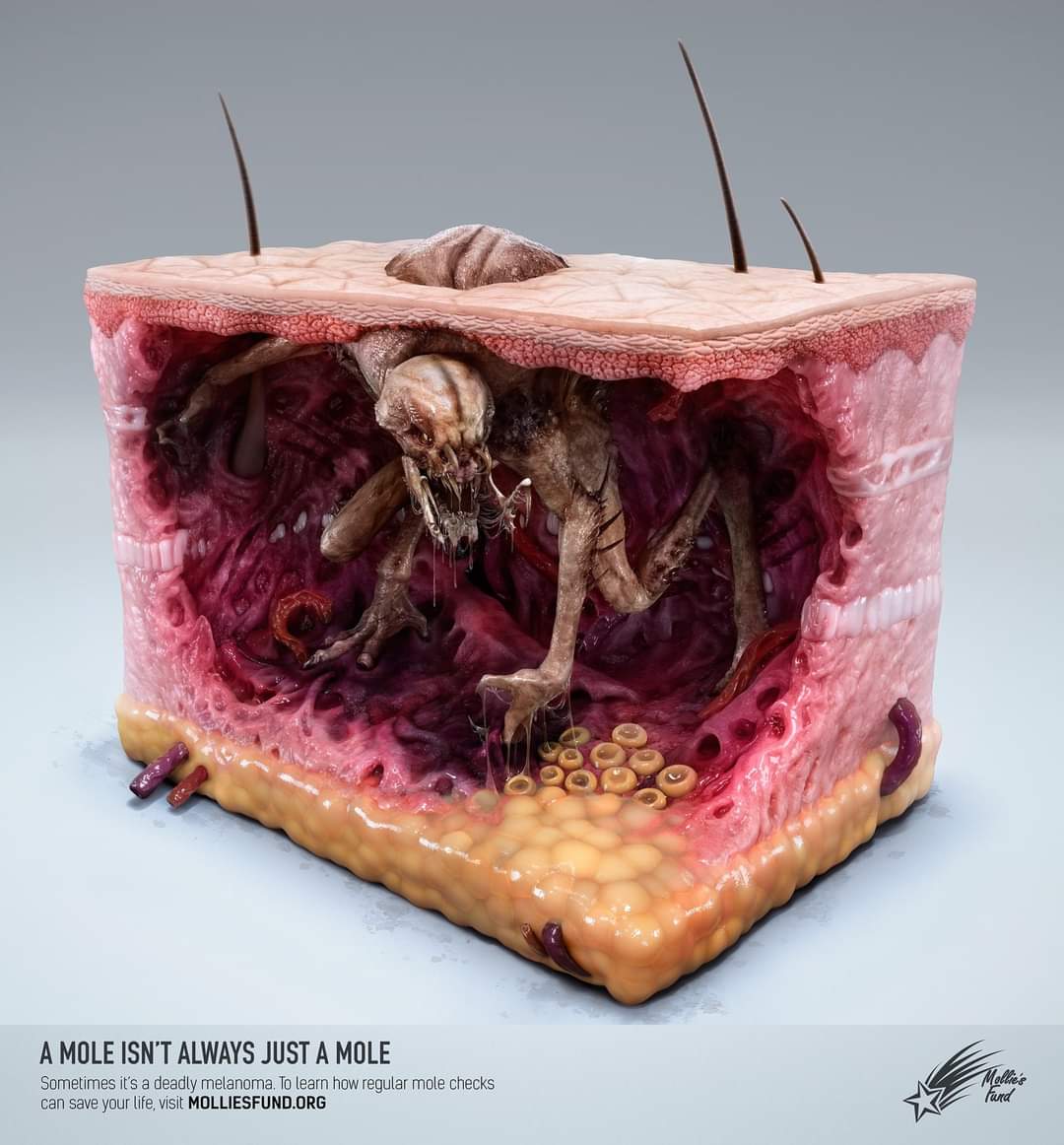 InformaCosmos's tweet photo. MONSTRUOS DE MELANOMA.

Estas ilustraciones son parte de una campaña publicitaria que pretende concientizar sobre el cáncer de piel.

Estas imágenes fueron publicadas por Medical Sources HD, para dar un mensaje claro: no todo lunar o bulto en la piel es insignificante.

Siempre debemos tener cuidado de cualquier señal lo insignificante que parezca, a veces esa manchita en la piel, puede esconder algo terrible y aterrador.

Como pueden ver, las ilustraciones son realmente impresionantes. Nos dan otro concepto de cómo se vería el cáncer de piel, y el daño que nos ocasionaría.

* El melanoma es un tipo de cáncer de piel que se origina cuando los melanocitos (las células que dan a la piel su color bronceado o marrón) comienzan a crecer fuera de control.

El melanoma también puede manifestarse en los ojos y, rara vez, dentro del cuerpo, como en la nariz o la garganta.

La causa exacta de todos los melanomas no está clara, pero la exposición a la radiación ultravioleta (UV) de la luz solar o de las lámparas y de las camas solares aumenta el riesgo de tener melanoma.
