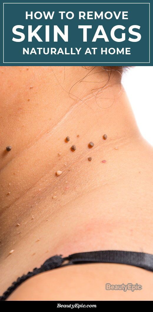 Threading Skin Tags Pos_Reference 🦋 on Twitter: