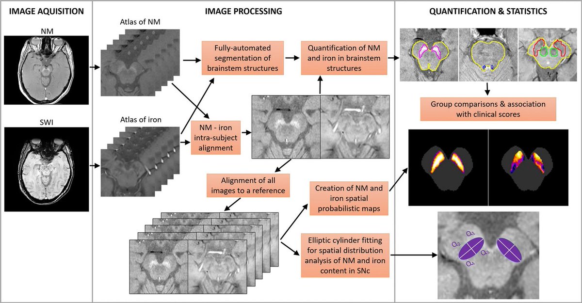 ScienceofPD's tweet image. Brainstem neuromelanin &amp;amp; iron MRI reveals a signature for idiopathic (N=39) &amp;amp; LRRK2 (N=24) #Parkinsons cases; "While the SNc was a good discriminator between PD patients &amp;amp; controls, the LC was the structure that best discriminated among PD subgroups"
nature.com/articles/s4153…