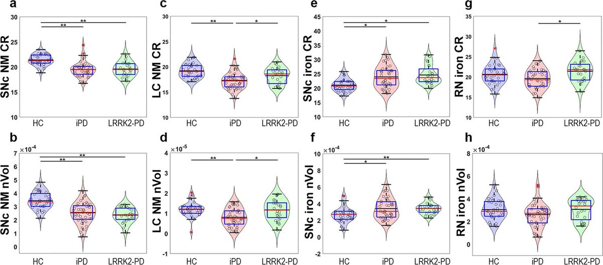 ScienceofPD's tweet image. Brainstem neuromelanin &amp;amp; iron MRI reveals a signature for idiopathic (N=39) &amp;amp; LRRK2 (N=24) #Parkinsons cases; "While the SNc was a good discriminator between PD patients &amp;amp; controls, the LC was the structure that best discriminated among PD subgroups"
nature.com/articles/s4153…