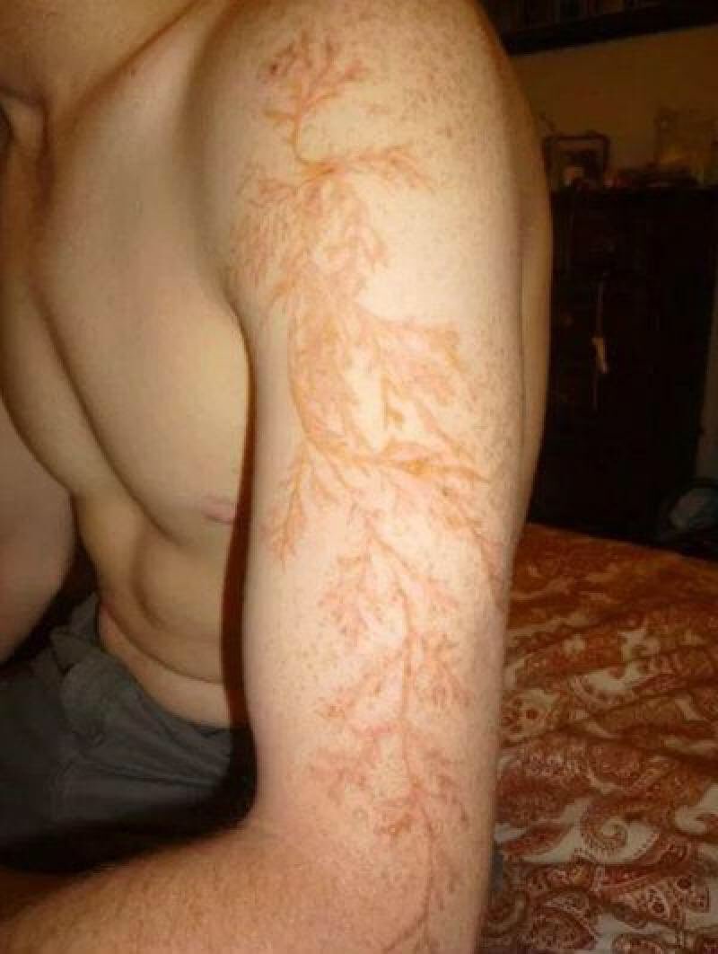 guinean224's tweet photo. Lorsqu’une personne se fait frapper par la foudre, ces motifs appelés « figure de Lichtenberg » se dessinent sur sa peau https://t.co/hX9QATcAkj