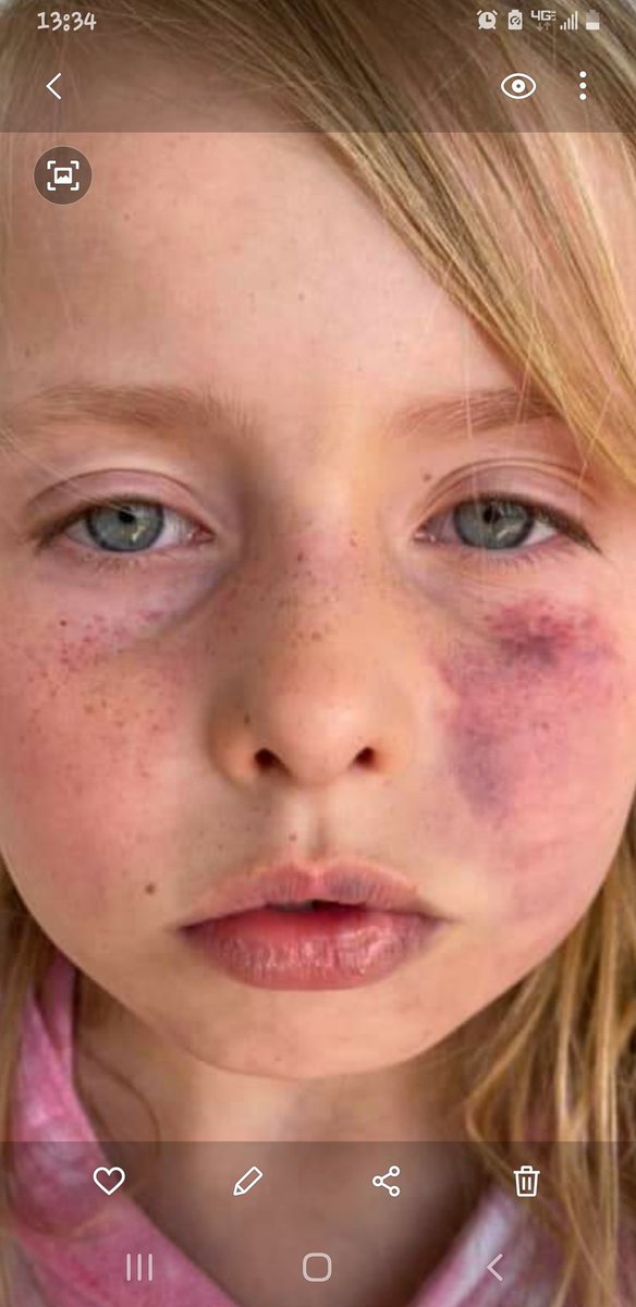 JusticeAdvocate's tweet photo. @OklahomaKids @Shers_Sparks @OklahomaWatch @OKDHS @Okla_OAG @mariashriver @kokonews @NewsOn6 @KTULNews
@OKCFOX @FOX23
 8 year old girl abused by her adoptive mother. No charges filed against adoptive mother yet. Wants to be returned to her biological family where she feels safe.
#JusticeForKinzly https://t.co/mzcUmY4fCq