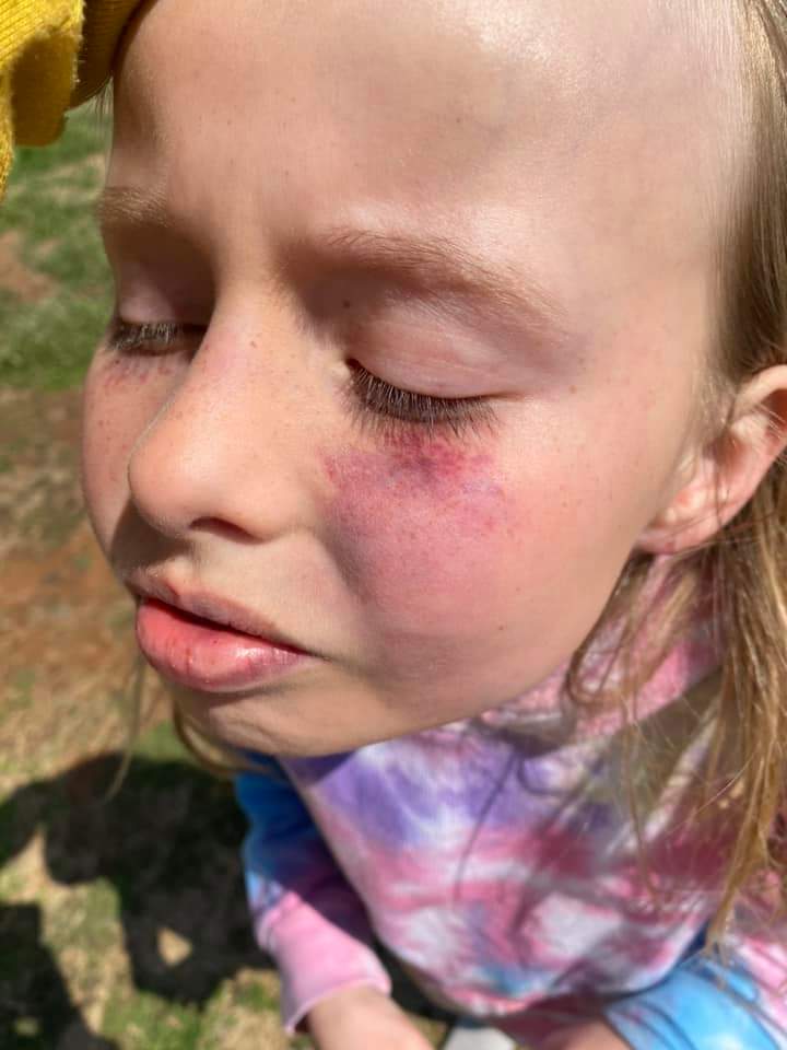 JusticeAdvocate's tweet photo. @OklahomaKids @Shers_Sparks @OklahomaWatch @OKDHS @Okla_OAG @mariashriver @kokonews @NewsOn6 @KTULNews
@OKCFOX @FOX23
 8 year old girl abused by her adoptive mother. No charges filed against adoptive mother yet. Wants to be returned to her biological family where she feels safe.
#JusticeForKinzly https://t.co/mzcUmY4fCq