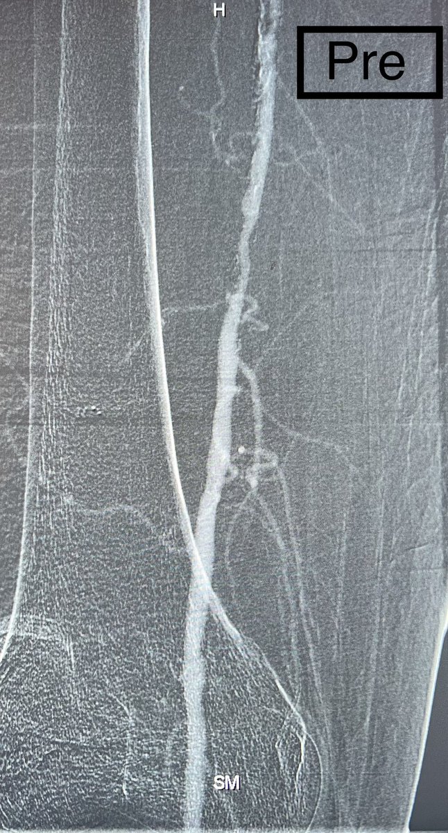 AMJan84's tweet photo. 60 M with #DM, #HTN, #DLP and stage 4 #CKD eGFR 18.
Patient presented to OSH with wet #gangrene of the right D1 and underwent D1 Ray #amputation.
The stump was ischemic for which he was offered a #BKA.
He was referred to me and arterial duplex showed diffuse SFA disease and below the knee disease 
Revascularization was done successfully using #CO2 by #Angiodroid with #zero iodinated contrast and 3V run off to the foot.
#CLTI #CLI #limbsalvage #PAD 
@imchospitalsa @Walidfitaihi @aymanalsul @AneesSindi @TaherDee @Rawanmqu @angiodroid @VascularSVS @CanadianSVS @McGillVascular @UHVascular @UHCardsFellows