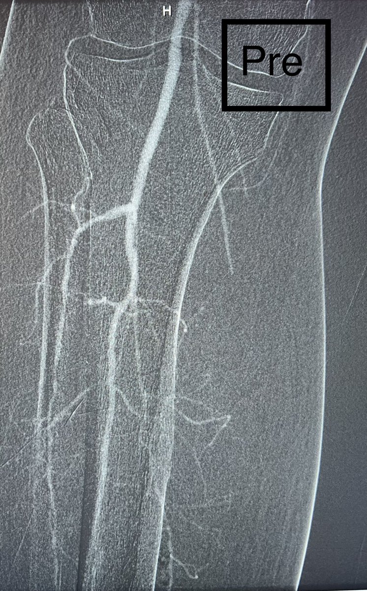 AMJan84's tweet photo. 60 M with #DM, #HTN, #DLP and stage 4 #CKD eGFR 18.
Patient presented to OSH with wet #gangrene of the right D1 and underwent D1 Ray #amputation.
The stump was ischemic for which he was offered a #BKA.
He was referred to me and arterial duplex showed diffuse SFA disease and below the knee disease 
Revascularization was done successfully using #CO2 by #Angiodroid with #zero iodinated contrast and 3V run off to the foot.
#CLTI #CLI #limbsalvage #PAD 
@imchospitalsa @Walidfitaihi @aymanalsul @AneesSindi @TaherDee @Rawanmqu @angiodroid @VascularSVS @CanadianSVS @McGillVascular @UHVascular @UHCardsFellows