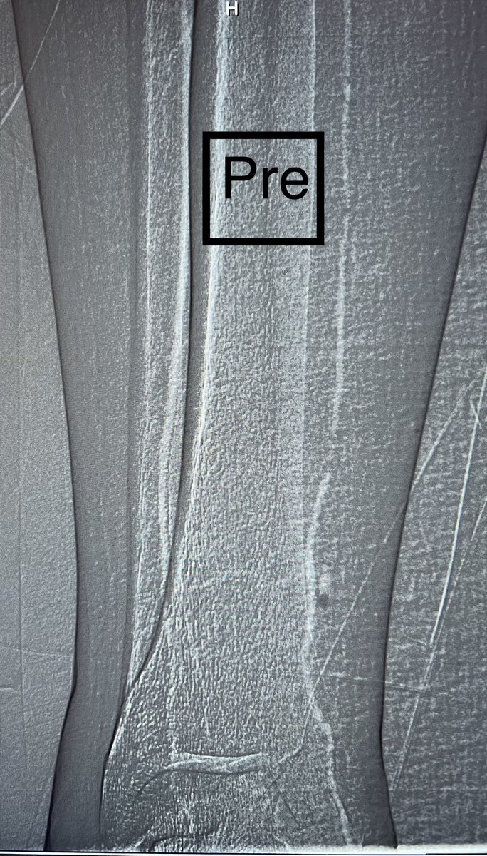 AMJan84's tweet photo. 60 M with #DM, #HTN, #DLP and stage 4 #CKD eGFR 18.
Patient presented to OSH with wet #gangrene of the right D1 and underwent D1 Ray #amputation.
The stump was ischemic for which he was offered a #BKA.
He was referred to me and arterial duplex showed diffuse SFA disease and below the knee disease 
Revascularization was done successfully using #CO2 by #Angiodroid with #zero iodinated contrast and 3V run off to the foot.
#CLTI #CLI #limbsalvage #PAD 
@imchospitalsa @Walidfitaihi @aymanalsul @AneesSindi @TaherDee @Rawanmqu @angiodroid @VascularSVS @CanadianSVS @McGillVascular @UHVascular @UHCardsFellows