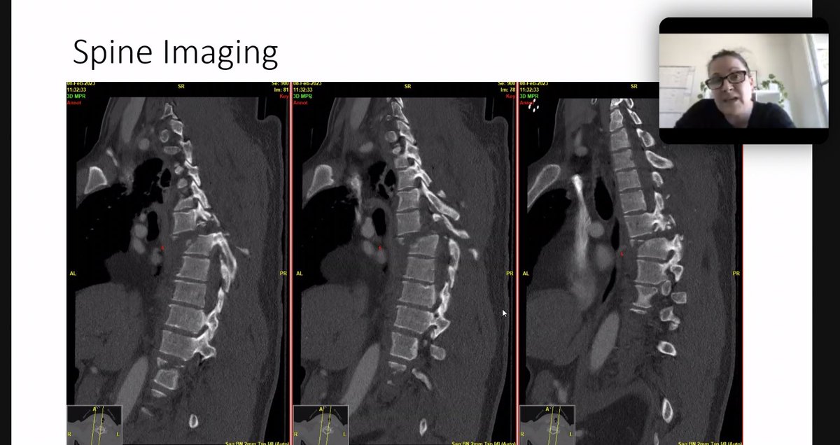 Mayo Clinic Neurosurgery Residency (@mayonsgyres) on Twitter photo Thrilled to have <a href="/SpineTharin/">Suzanne Tharin MD PhD</a> <a href="/StanfordNsurg/">Stanford Neurosurgery</a> as visiting faculty pulling double duty to discuss complex spine cases with residents, and then leading the <a href="/AANSNeuro/">AANS</a> <a href="/MayoClinicSOM/">Mayo Clinic Alix School of Medicine</a> @WINSneurosurge1 Sundt Neurosurgery Interest Group series on Women in Neurosurgery Thrilled to have <a href="/SpineTharin/">Suzanne Tharin MD PhD</a> <a href="/StanfordNsurg/">Stanford Neurosurgery</a> as visiting faculty pulling double duty to discuss complex spine cases with residents, and then leading the <a href="/AANSNeuro/">AANS</a> <a href="/MayoClinicSOM/">Mayo Clinic Alix School of Medicine</a> @WINSneurosurge1 Sundt Neurosurgery Interest Group series on Women in Neurosurgery